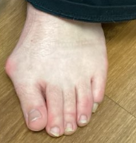 Patient with prominent bunion