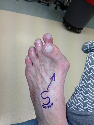 Clinical photograph of a bunion