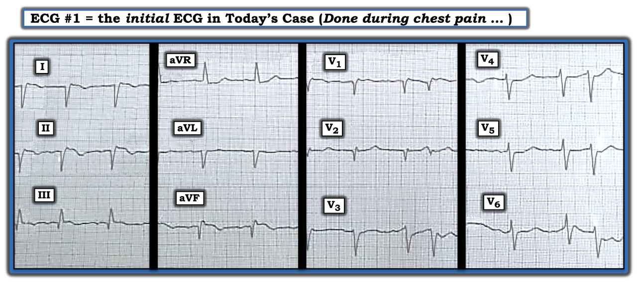 ECG Review Figure IMA 021523
