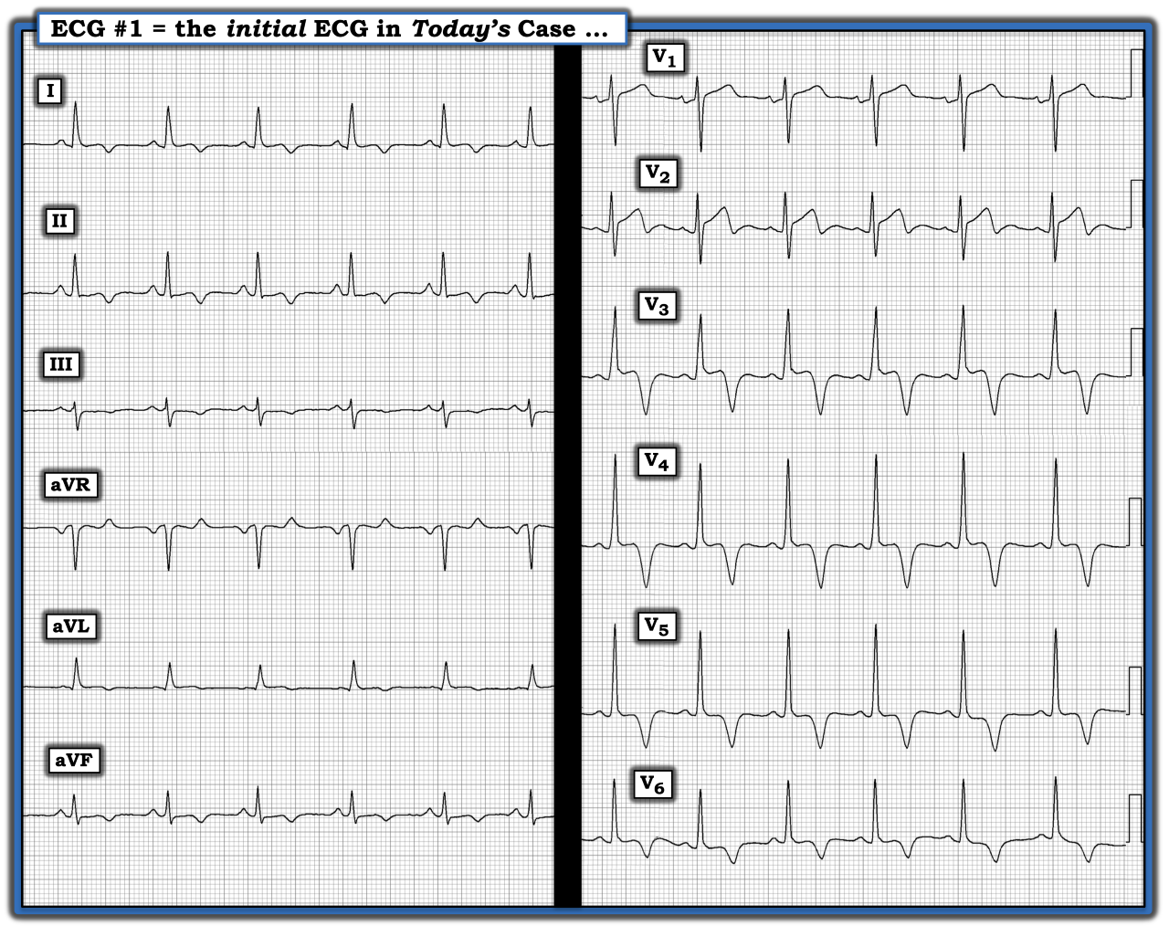 ECG Review Figure March 15 IM