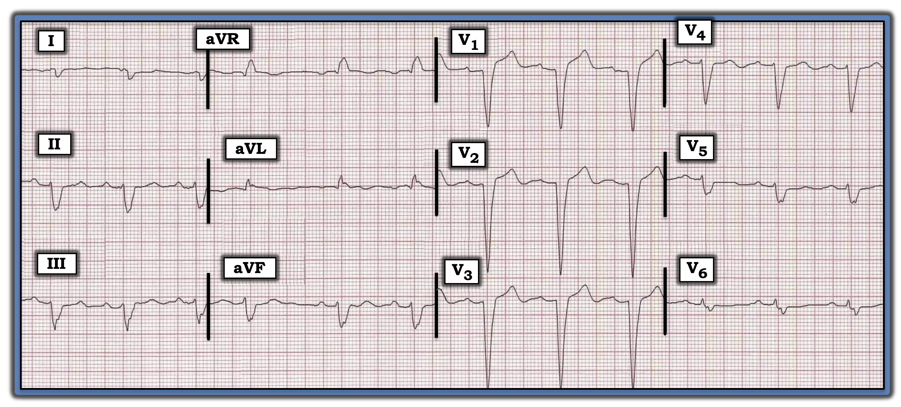 ECG Review Figure Aug. 15, 2023, IM
