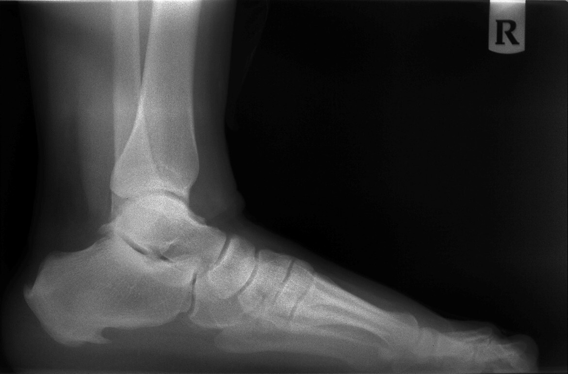 Posterior spur X-ray