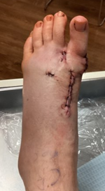 Post-operative bunion patient foot