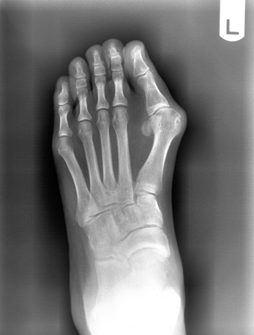 X-ray of a bunion
