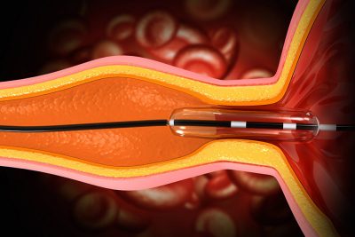 Balloon angioplasty Getty Images 2135413912
