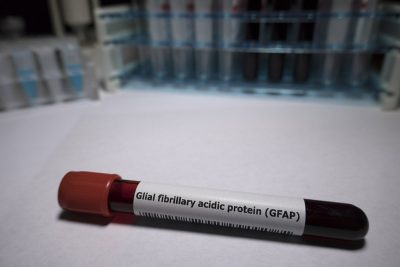 GFAP test Getty Images 1060236652