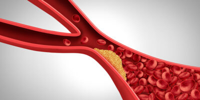 Carotid artery plaque Getty Images 2208877625