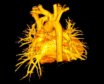 Ascending aorta Getty Images 2163993112