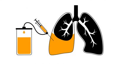 Thoracentesis Getty Images 1486662876