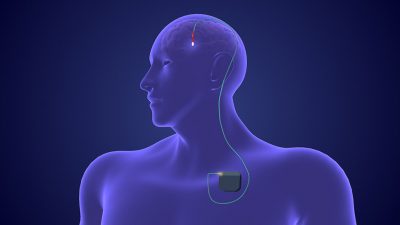 Deep brain stimulation Getty Images 1769992782