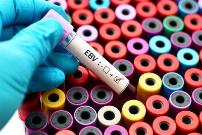 EBV blood sample Getty Images 698103320