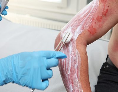 Burn management Getty Images 171137940