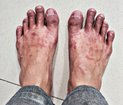 Frostbite Getty Images 1404025003