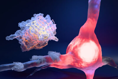 Amyloid plaque Getty Images 2203499176