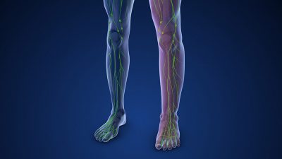 Lymphedema Getty Images 2160516070