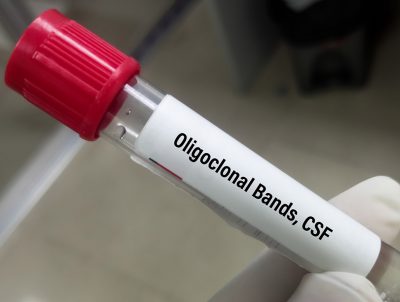 Oligoclonal bands Getty Images 1473534388