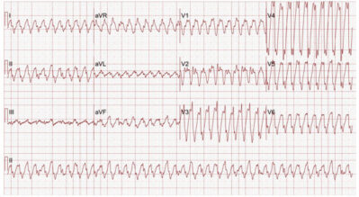 Ventricular Tachycardia