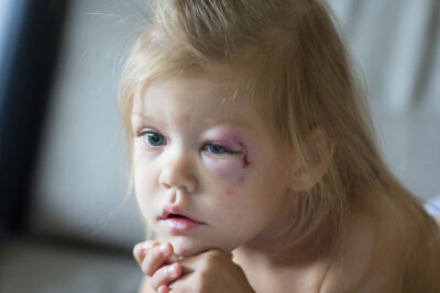 Peds facial trauma Getty Images 1205318424