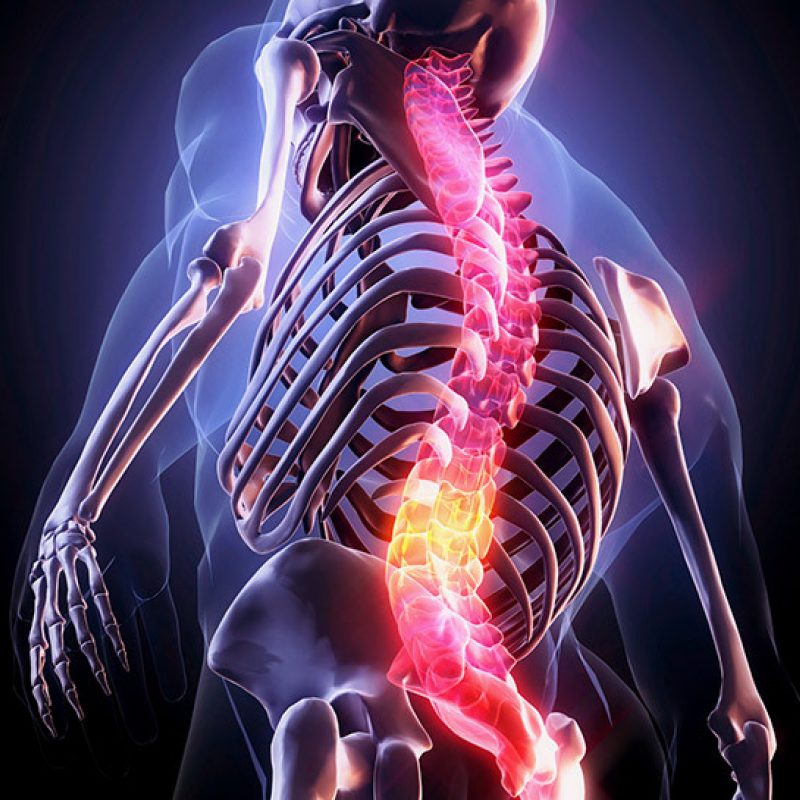 Uitstralingspijn - Chiropractor Lochristi