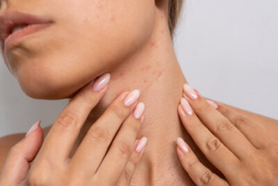 Acne Getty Images 2196168711