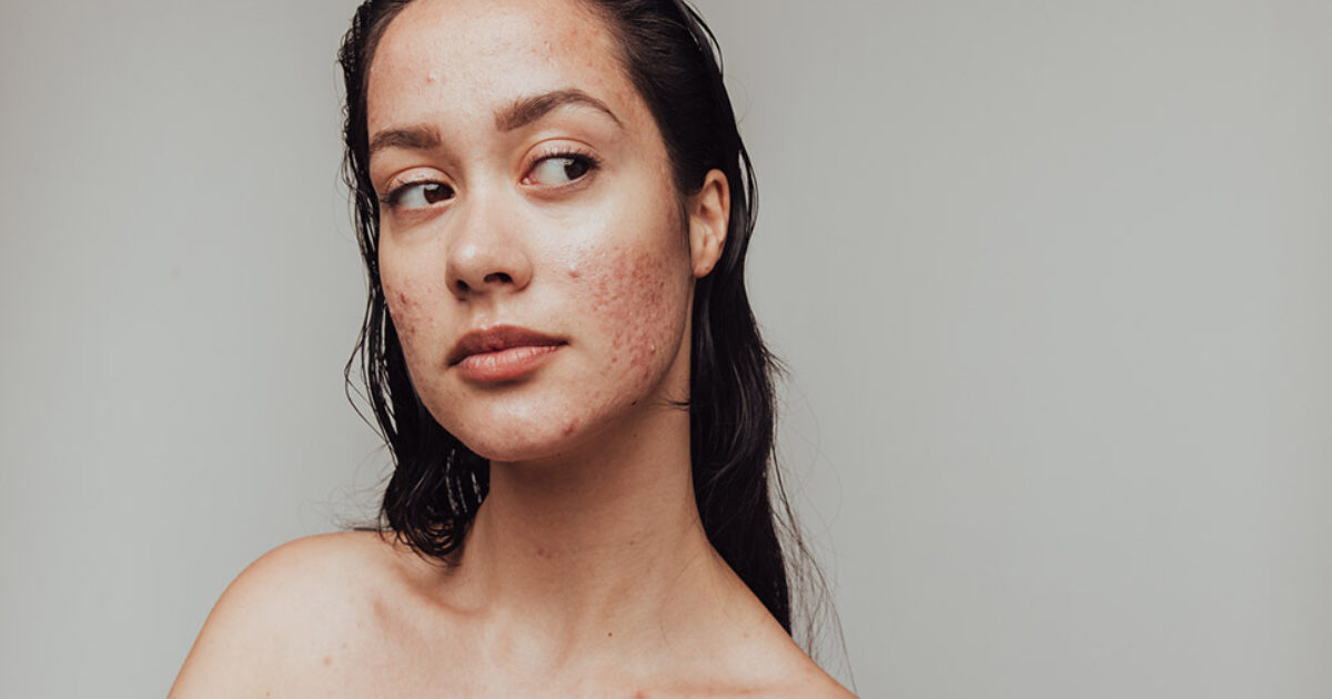 Spironolactone for the Treatment of Acne Vulgaris | Clinician.com