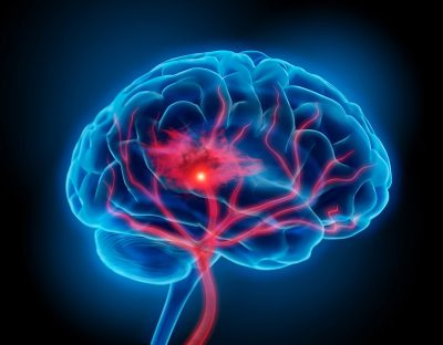 Stroke brain illustration Getty Images 1249957366