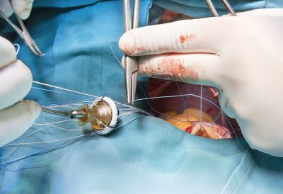Heart valve surgery Getty Images 645522568