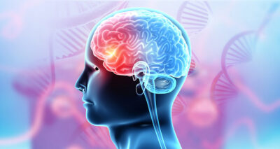 Ishemic stroke graphic Getty Images 1908937443