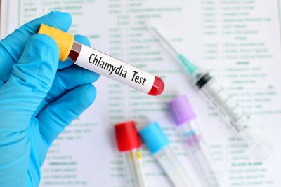 Chlamydia test Getty Images 517600300