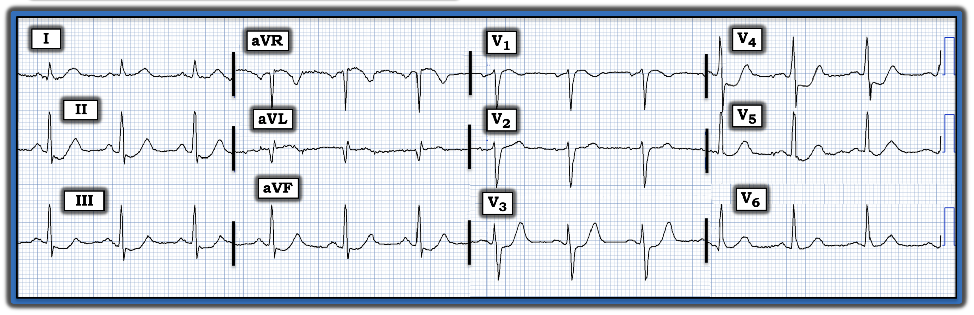 ECG Review 388