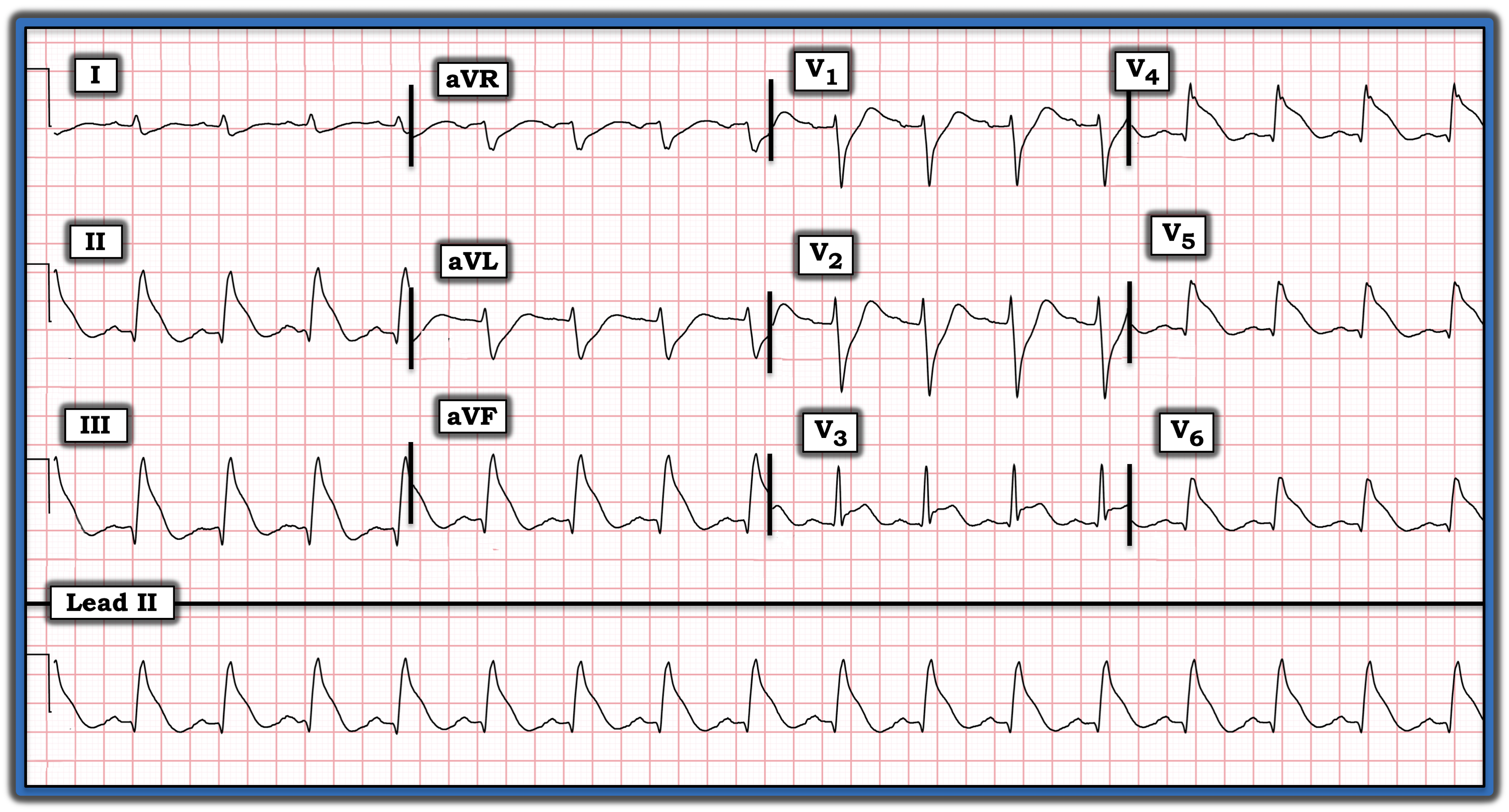 ECG Review 389