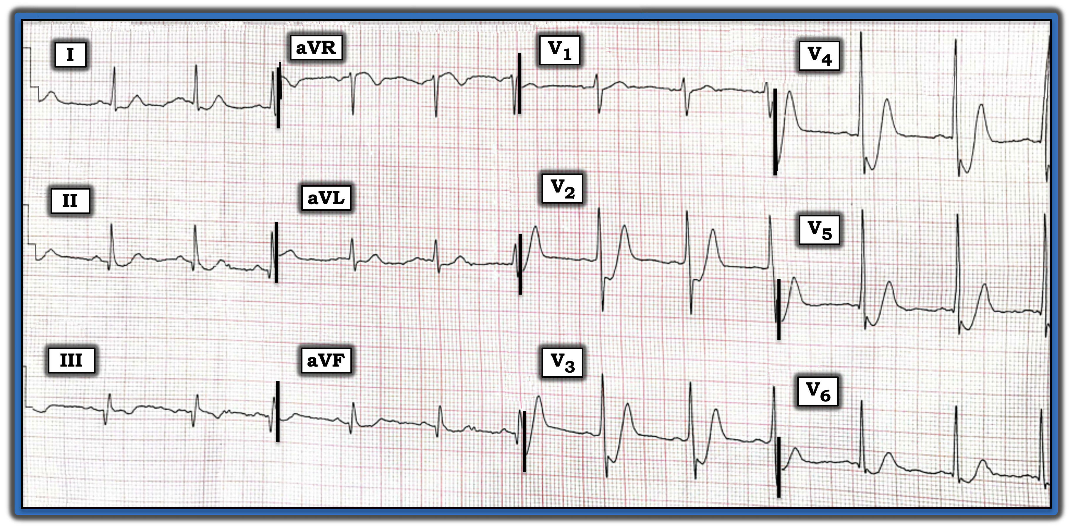 IM 041524 ECG Review