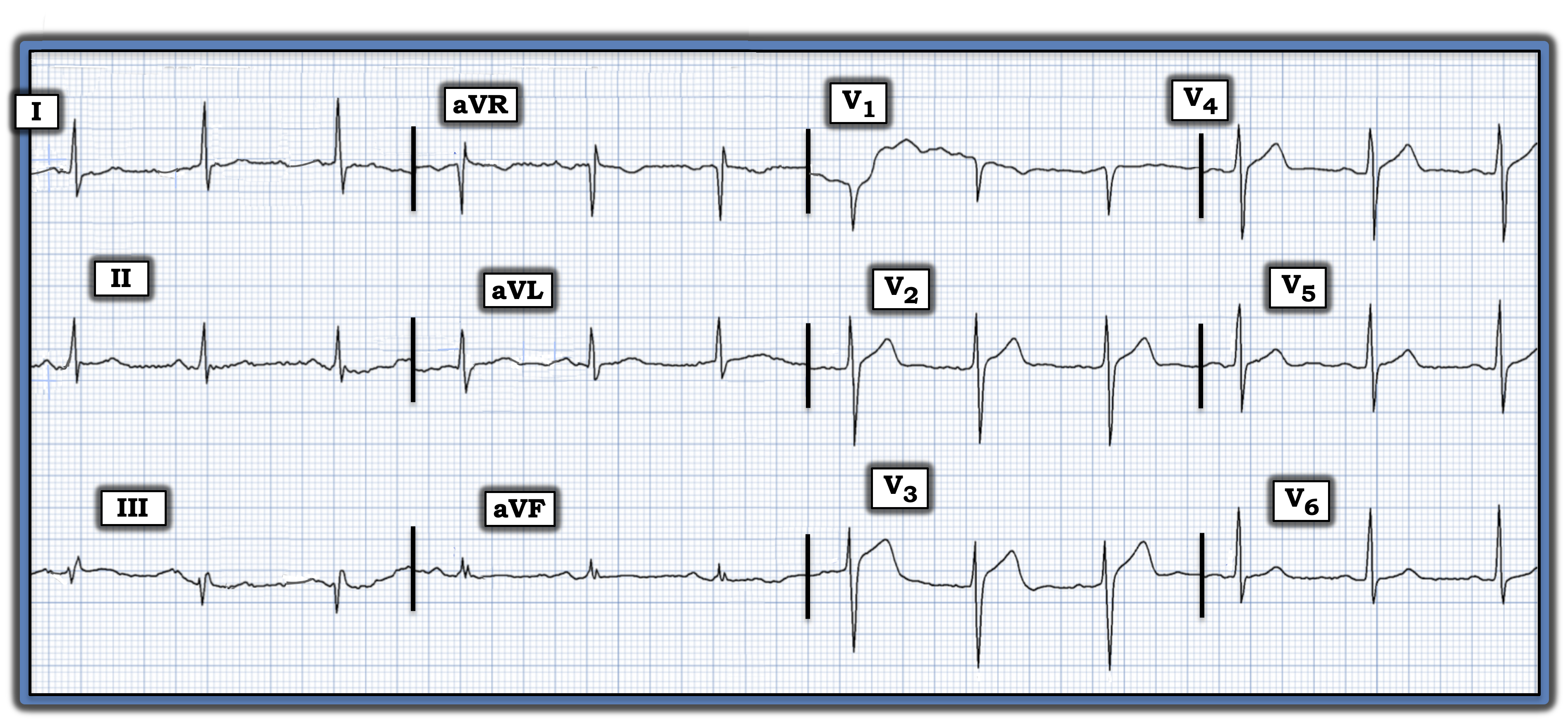 IM 051524 ECG Review