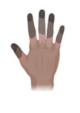 Grade 3 hand frostbite