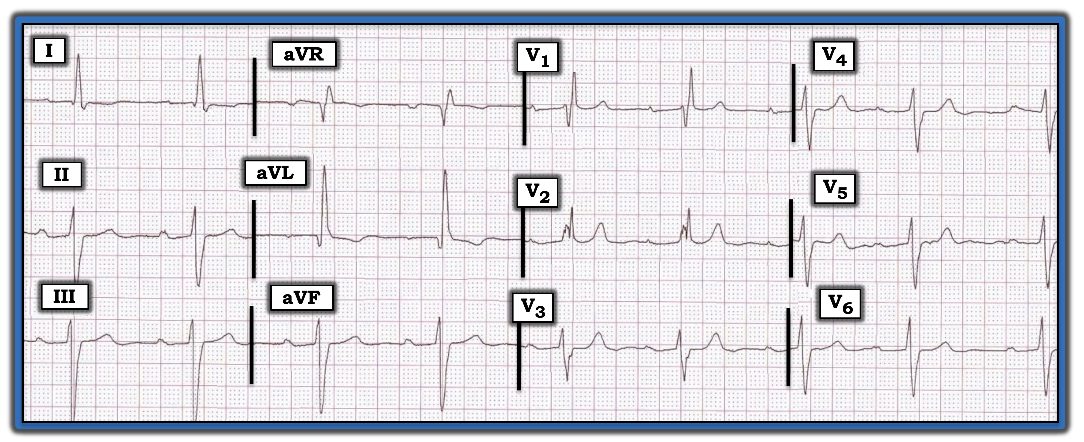 ECG Review July 15, 2023 IM