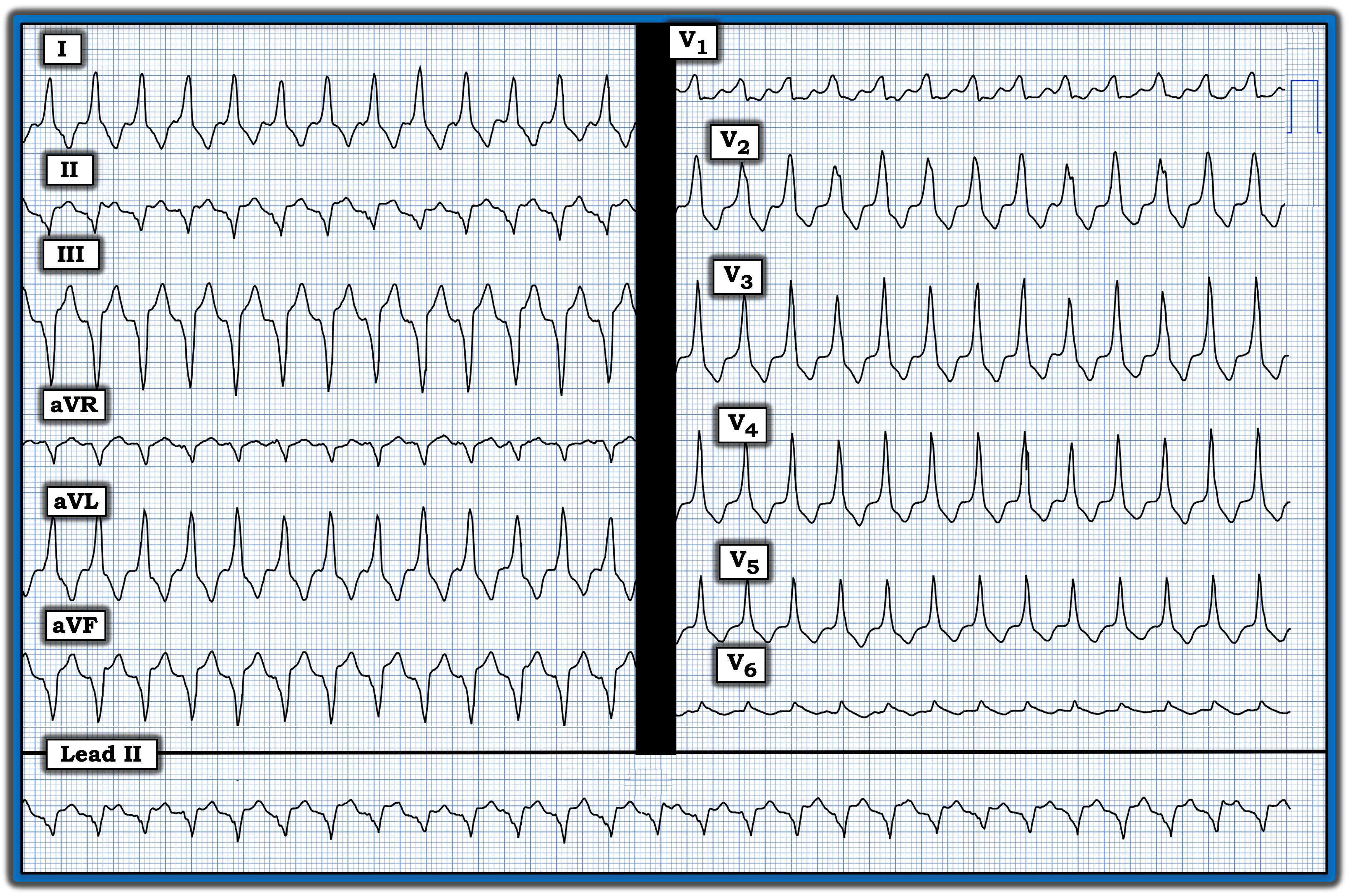 ECG review 404