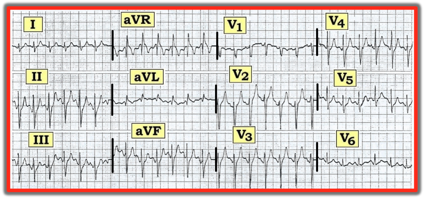 Peaked T Waves: Interpreting a High-Stakes ECG Finding