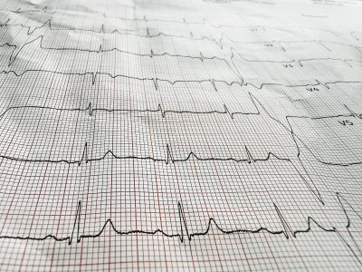 T waves on ECG