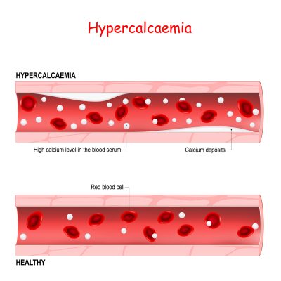 Hyperkalemia in bloodstream